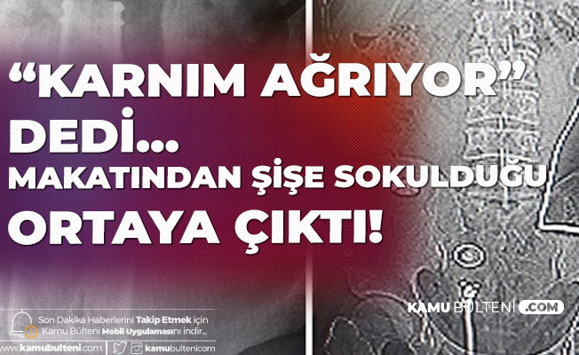 "Karnım Ağrıyor" Diye Gitti , 27 Yaşındaki Erkeğin Makatından Şişe Sokulduğu Ortaya Çıktı "Karnım Ağrıyor" Diye Gitti , 27 Yaşındaki Erkeğin Makatından Şişe Sokulduğu Ortaya Çıktı