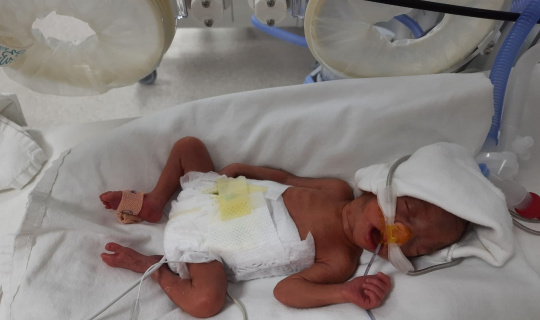 850 gram doğan Müge bebek, hayata tutunmayı başardı