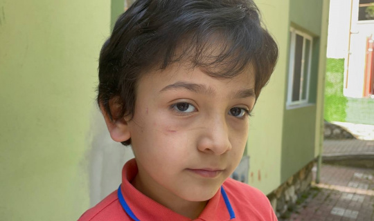 Sokak köpeği 8 yaşındaki Mehmet’in yanağını koparıyordu