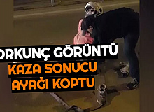 Feci Kaza Sonucu Ayağı Koptu